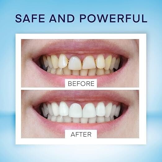 2‑Pack Teeth Whitening Pen – Jumbo Size Stain Remover Pen (Delicate)